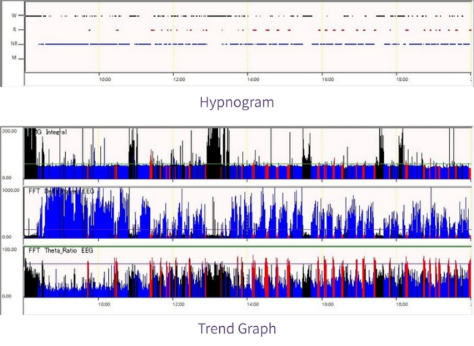 Hypnogram / Trend Graph